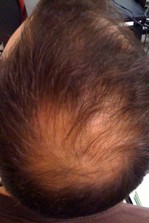 Hair Loss