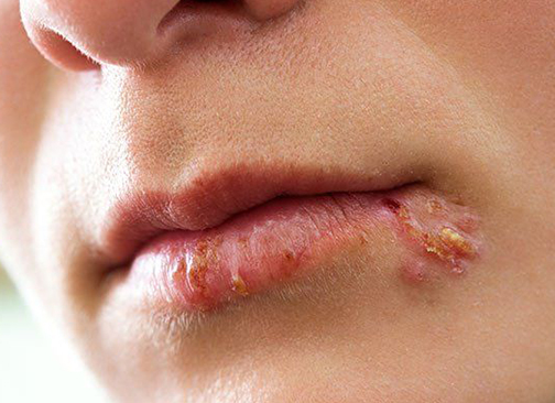 Cold sore treatment